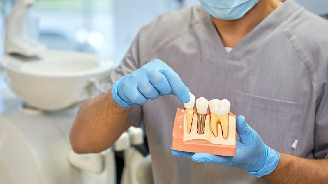 Are There Age Restrictions for Dental Implants